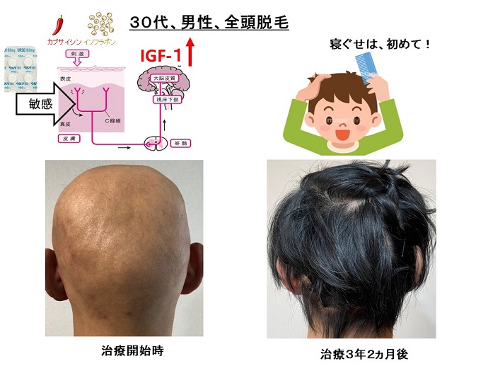 円形脱毛症　病院